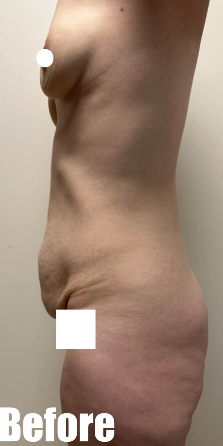 Before Image: Circumferential Mamacita Makeover - left-side