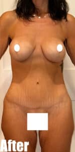 After Image: Breast Augmentation and Lift with tummy tuck