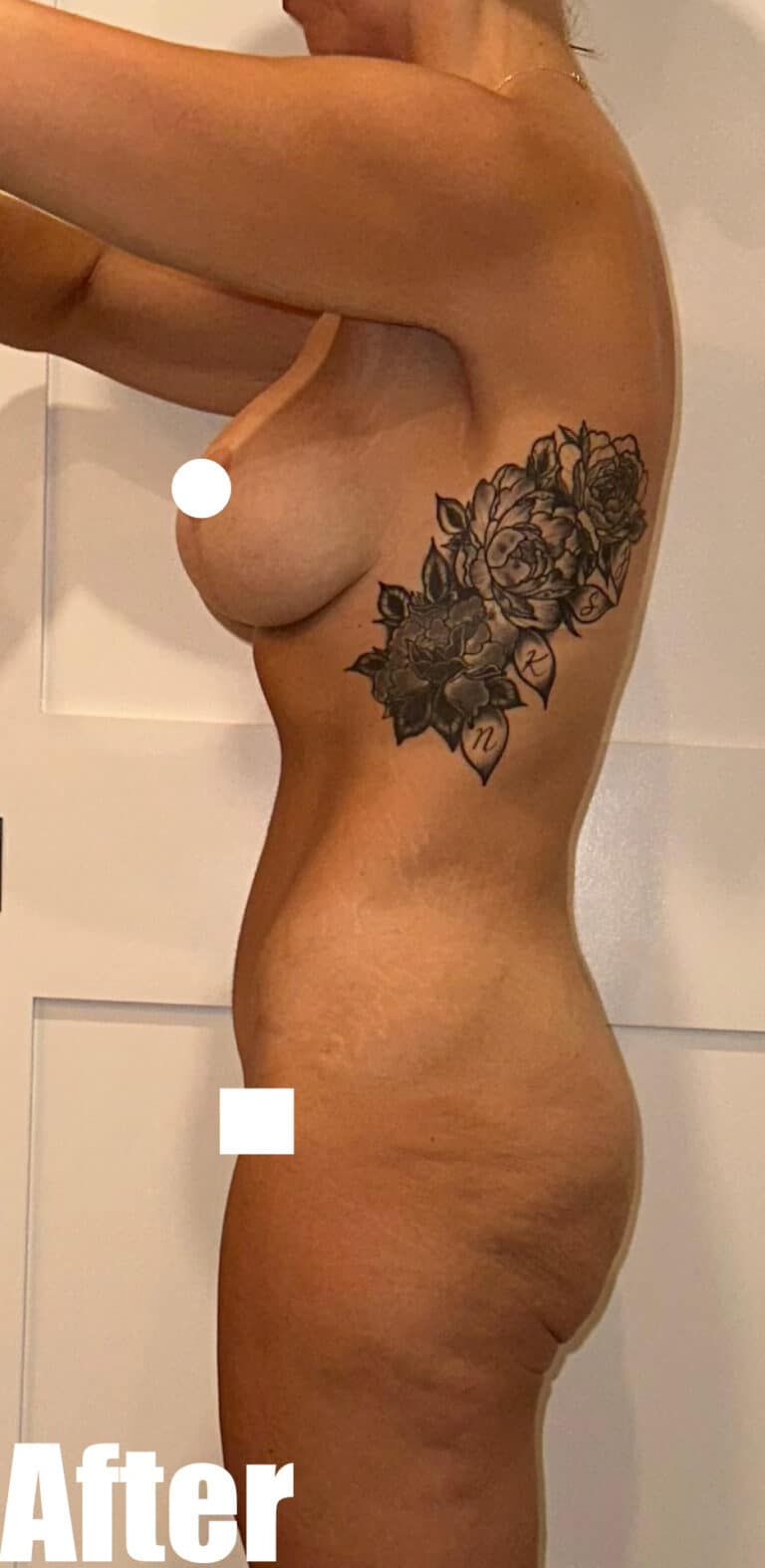 After Image: Breast Augmentation and Lift with tummy tuck - left-side