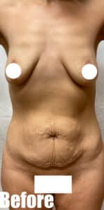 Before Image: Breast Augmentation and Lift with tummy tuck