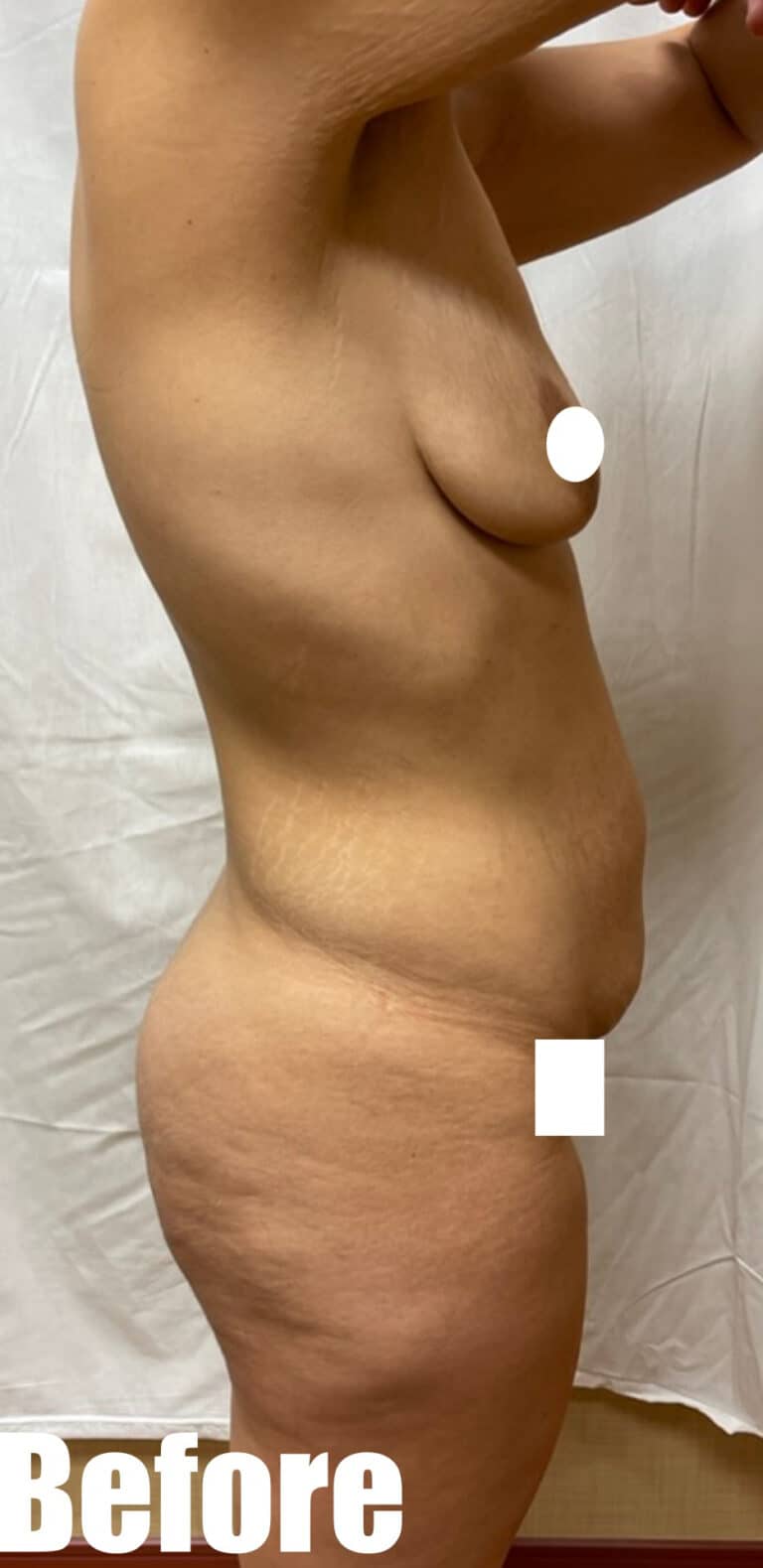 Before Image: Breast Augmentation and Lift with tummy tuck - right-side