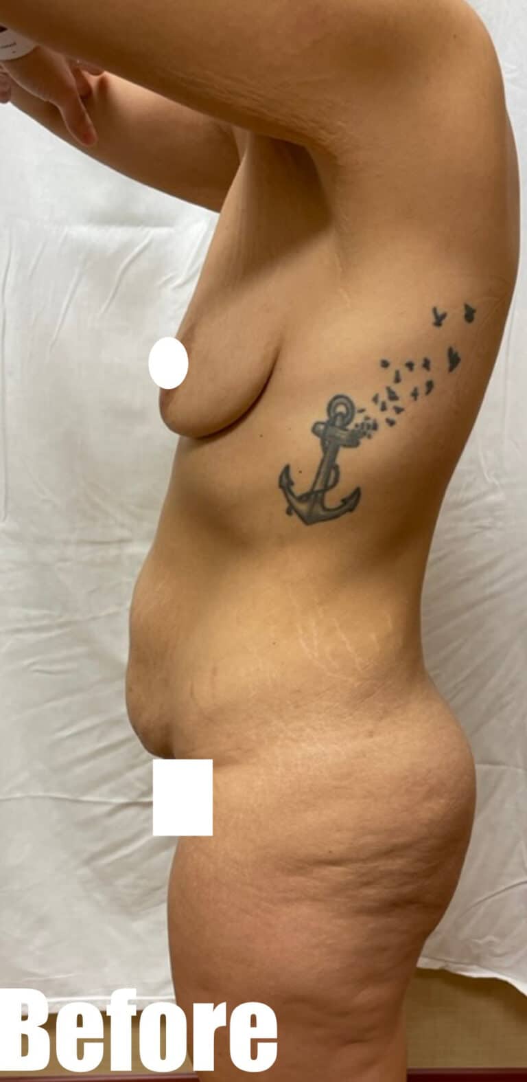 Before Image: Breast Augmentation and Lift with tummy tuck - left-side