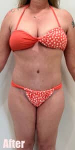 After Image: Breast Reduction and Lift with Circumferential Tummy Tuck