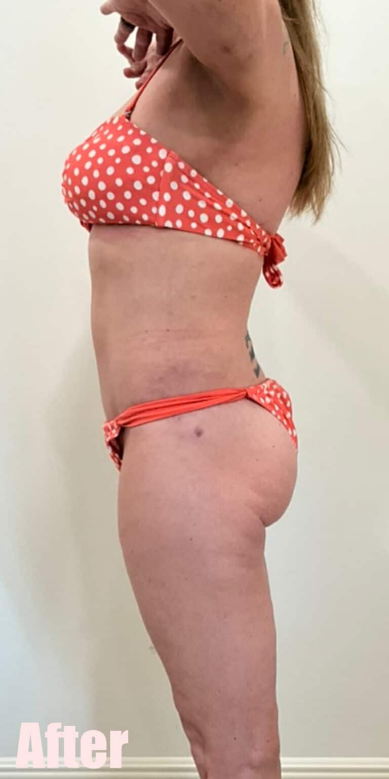 After Image: Breast Reduction and Lift with Circumferential Tummy Tuck - left-side