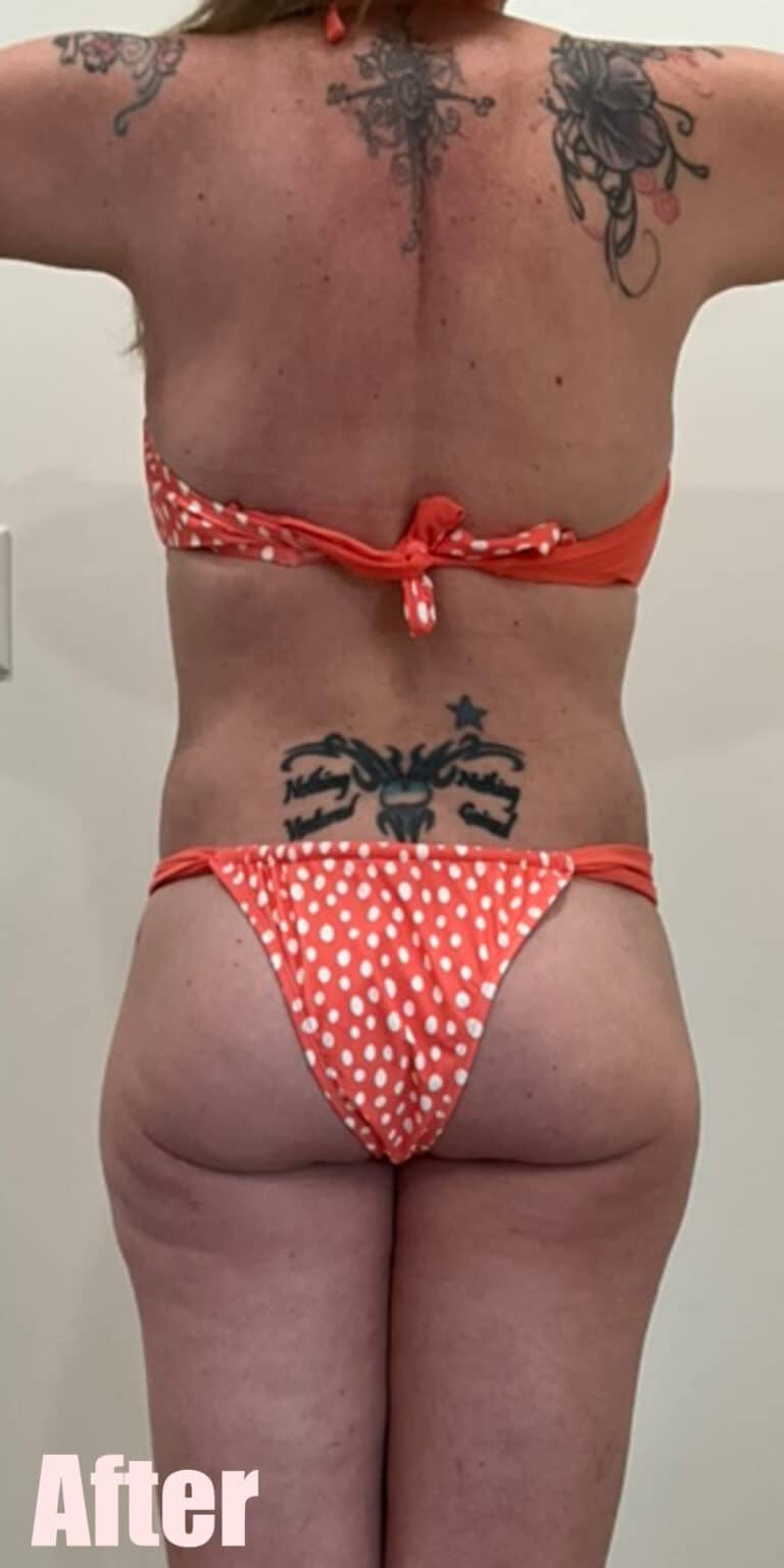 After Image: Breast Reduction and Lift with Circumferential Tummy Tuck - back