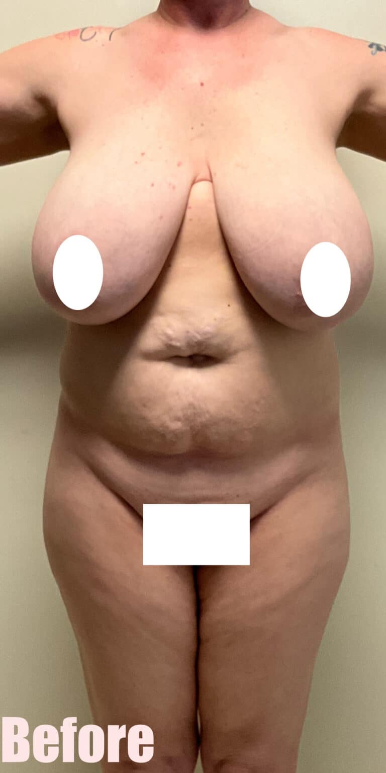 Before Image: Breast Reduction and Lift with Circumferential Tummy Tuck - front