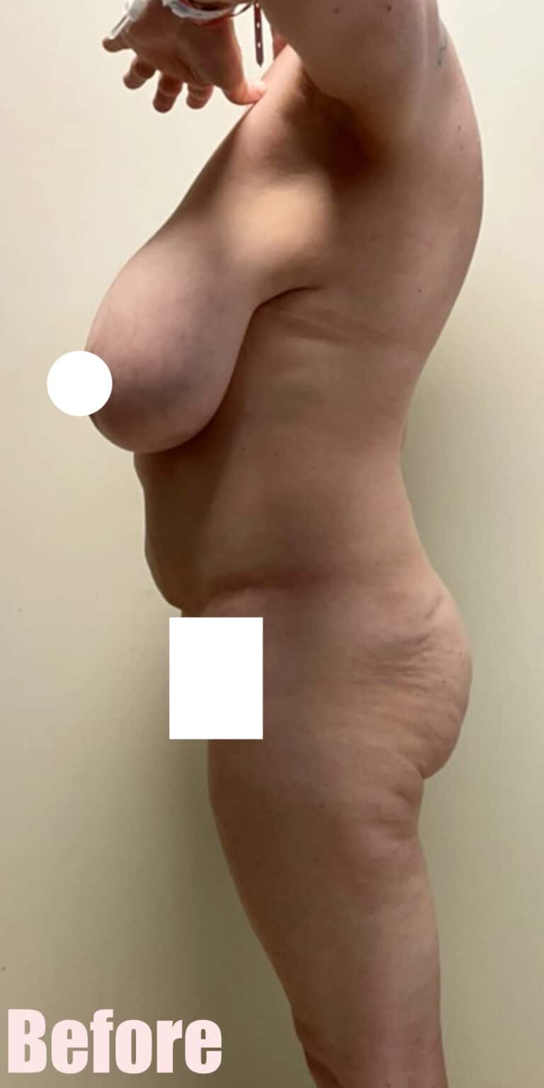 Before Image: Breast Reduction and Lift with Circumferential Tummy Tuck - left-side