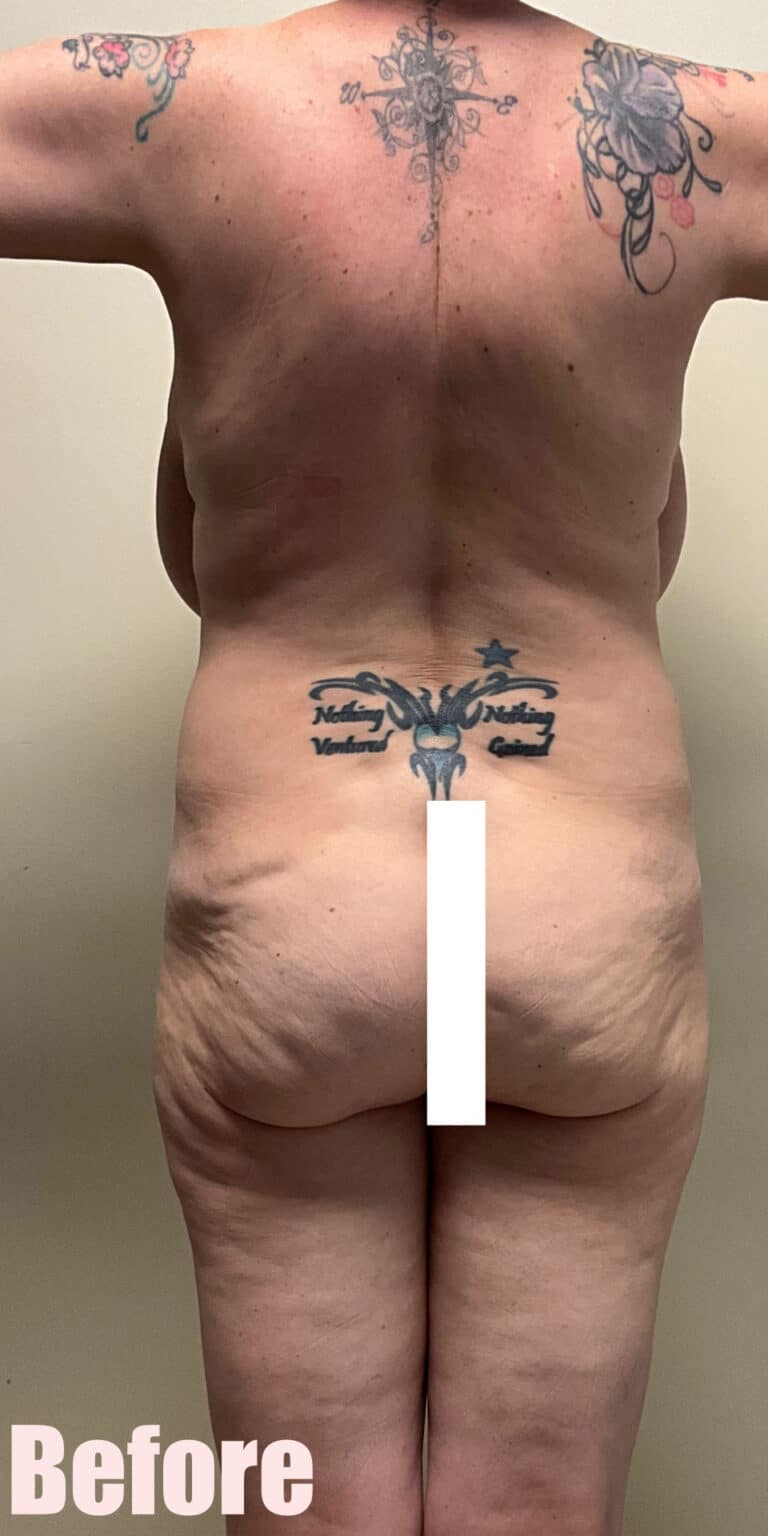 Before Image: Breast Reduction and Lift with Circumferential Tummy Tuck - back