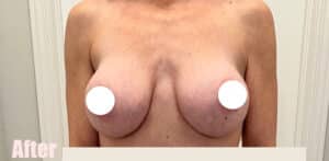 After Image: Breast Augmentation