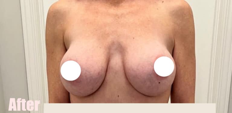 After Image: Breast Augmentation - front