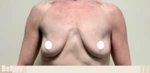 Before Image: Breast Augmentation