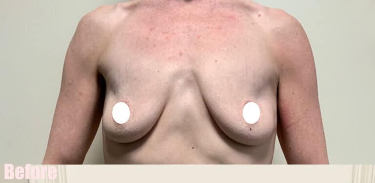 Before Image: Breast Augmentation - front