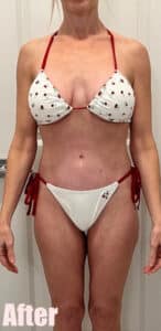 After Image: Circumferential Mommy Makeover