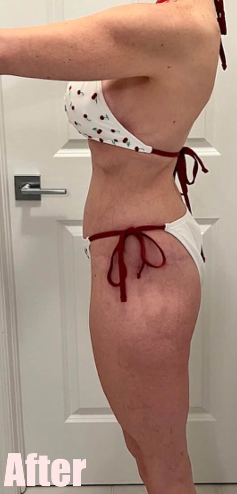 After Image: Circumferential Mommy Makeover - left-side