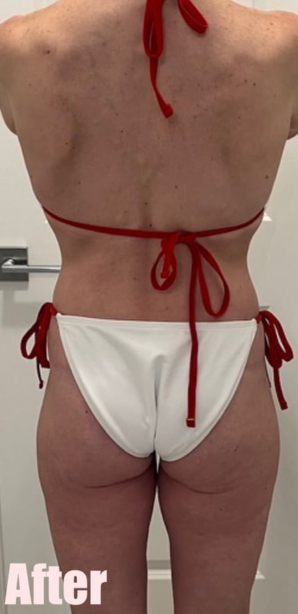 After Image: Circumferential Mommy Makeover - back