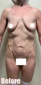 Before Image: Circumferential Mommy Makeover