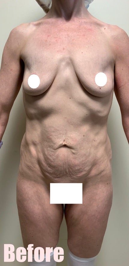 Before Image: Circumferential Mommy Makeover - front