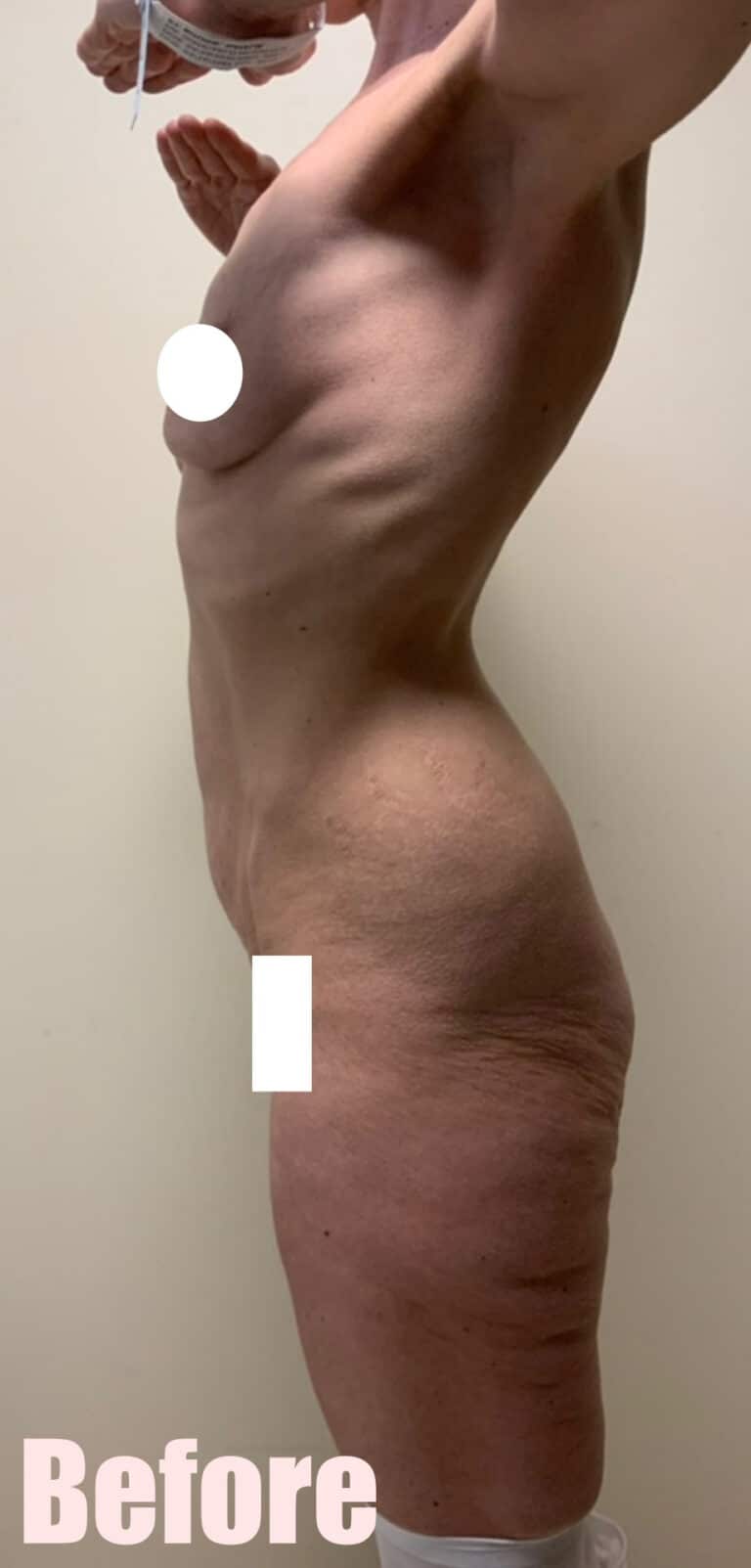 Before Image: Circumferential Mommy Makeover - left-side