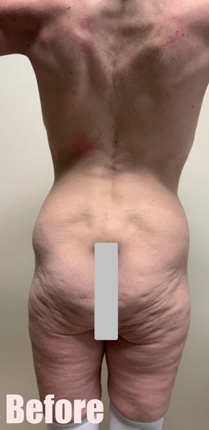 Before Image: Circumferential Mommy Makeover - back