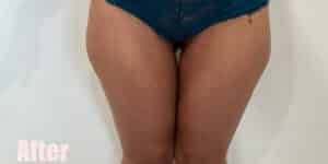 After Image: Crescent Thigh Lift