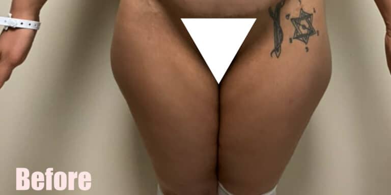 Before Image: Crescent Thigh Lift - front