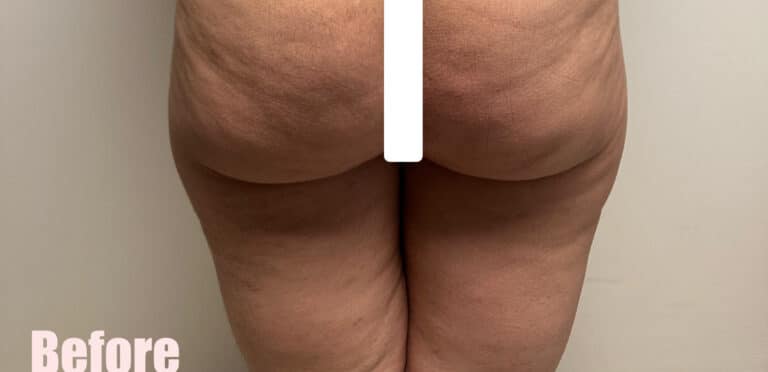 Before Image: Crescent Thigh Lift - back