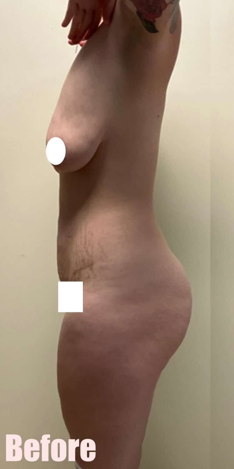 Before Image: 29F Circumferential Mamacita Makeover - left-side