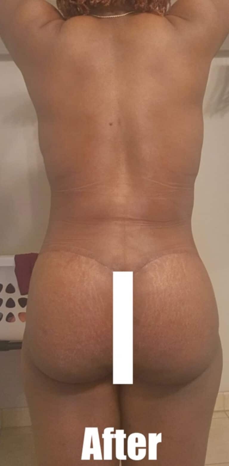 After Image: 35 Female Mommy Makeover - back