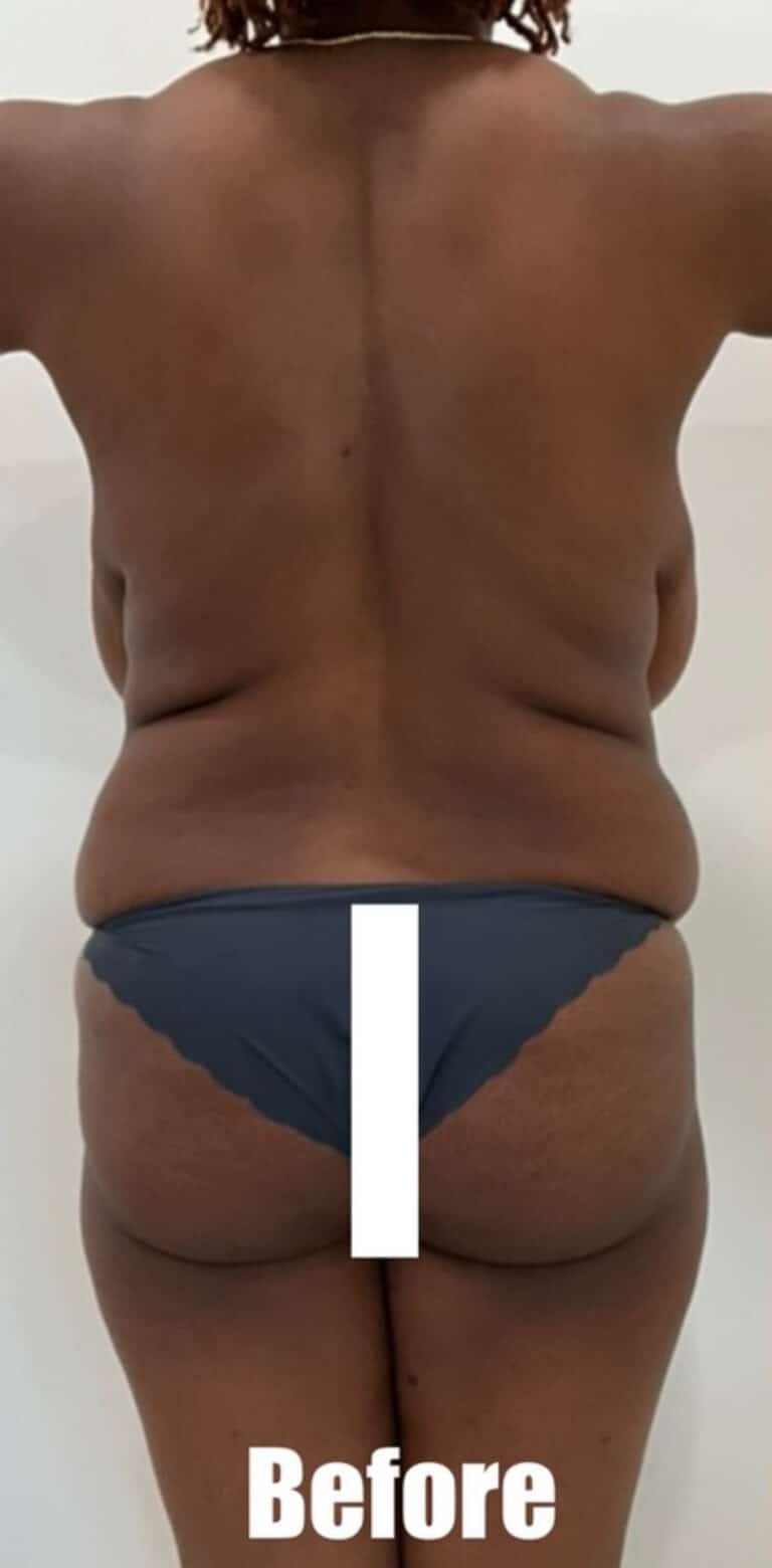 Before Image: 35 Female Mommy Makeover - back