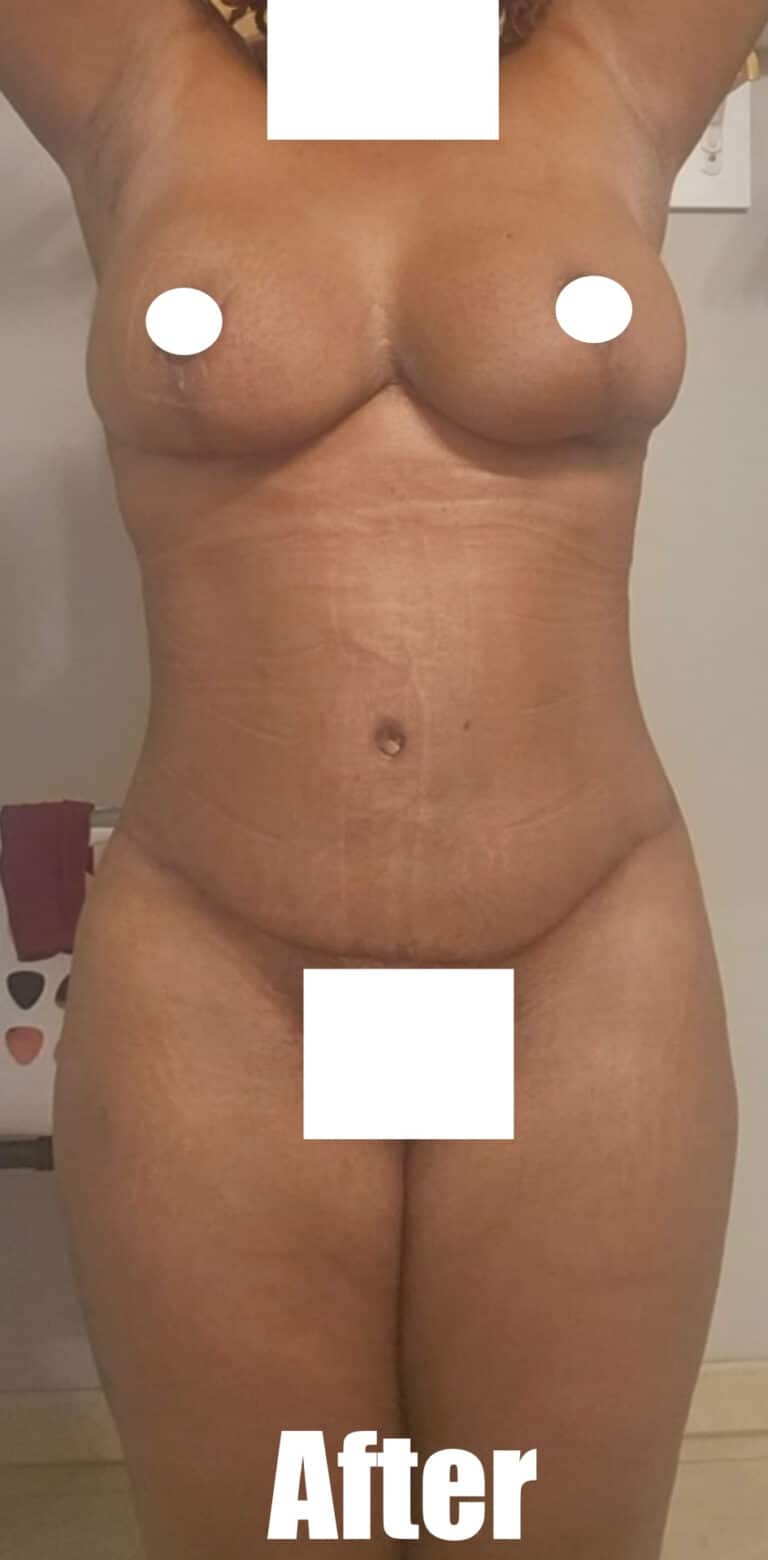 After Image: 35 Female Mommy Makeover - front
