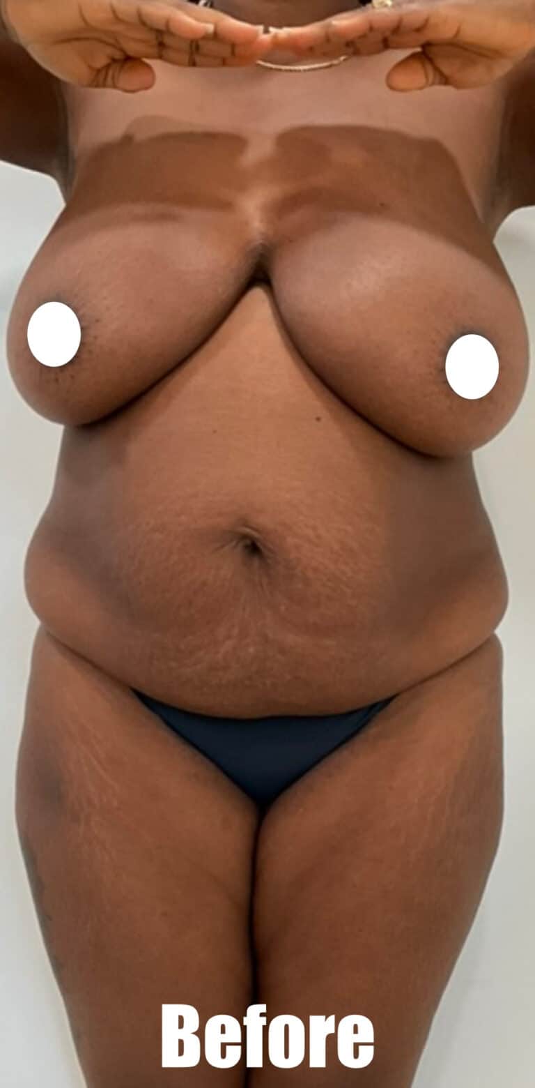 Before Image: 35 Female Mommy Makeover - front