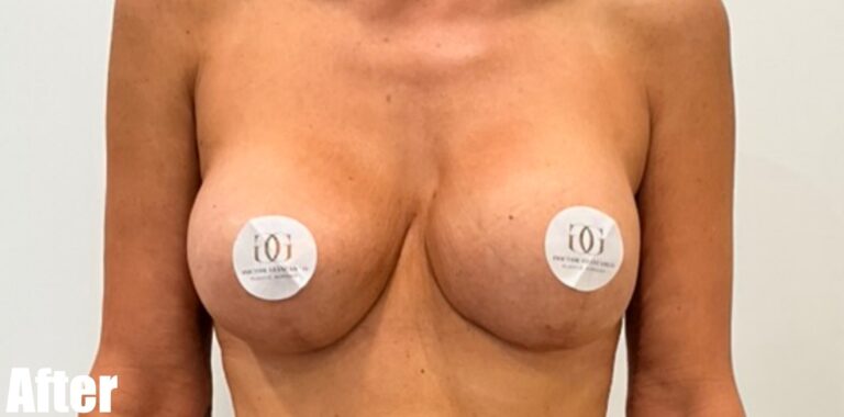 After Image: Breast Revision - front