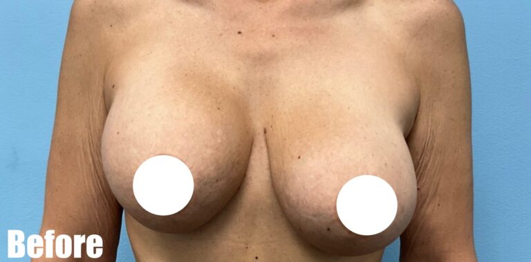 Before Image: Breast Revision - front
