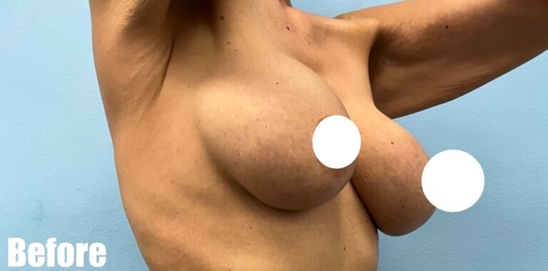 Before Image: Breast Revision - right-front-oblique