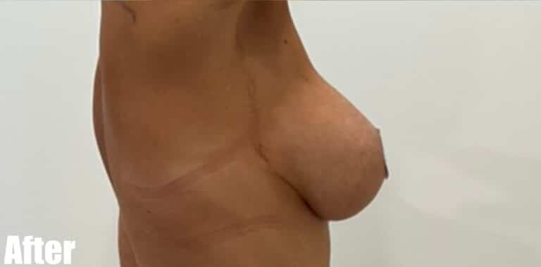 After Image: Breast Revision - right-side