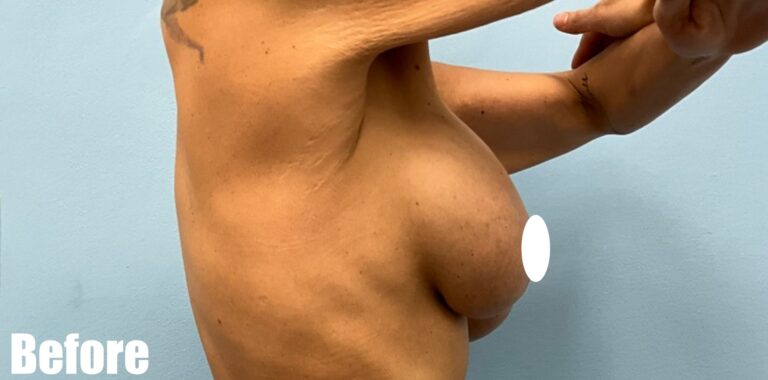 Before Image: Breast Revision - right-side