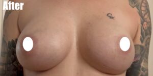 After Image: Breast Augmentation