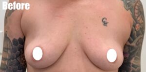 Before Image: Breast Augmentation