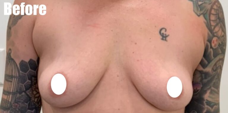 Before Image: Breast Augmentation - front