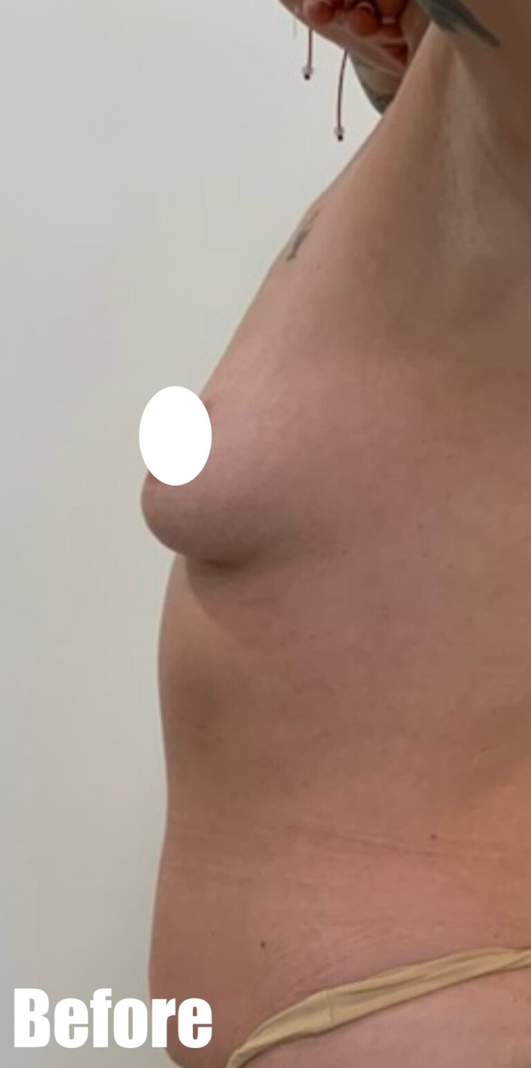 Before Image: Breast Augmentation - left-side