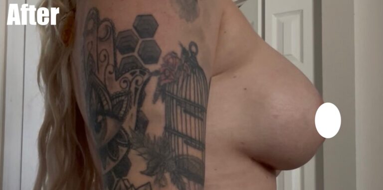 After Image: Breast Augmentation - right-side