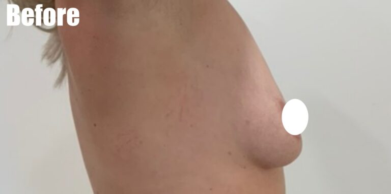 Before Image: Breast Augmentation - right-side