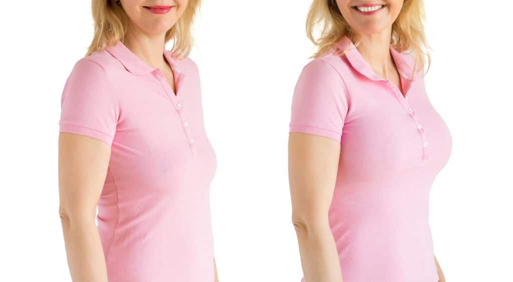 Smiling woman in pink shirt, before and after a breast lift in Boca Raton