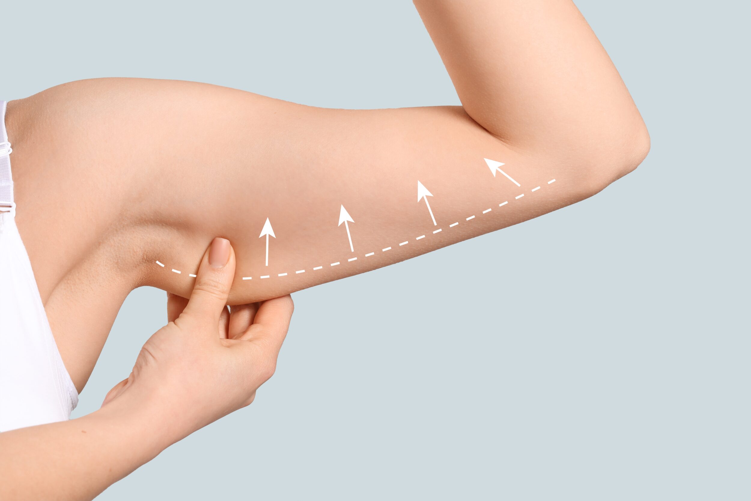 Woman pinches loose skin on her upper arm prior to an arm lift in Boca Raton