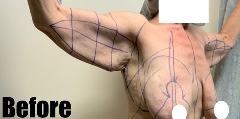 Before Image: Arm Lift - right-front-oblique