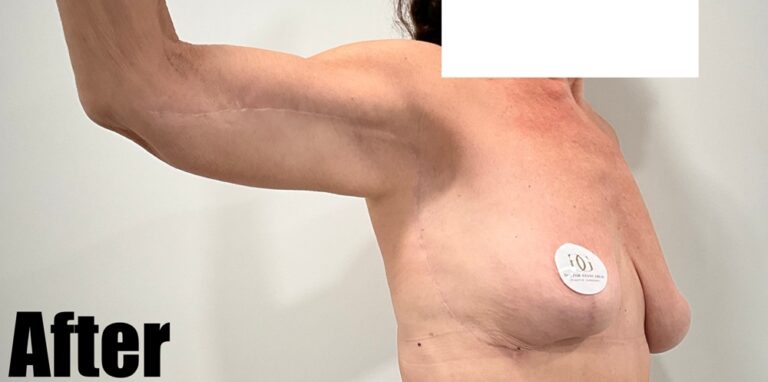 After Image: Arm Lift - right-front-oblique