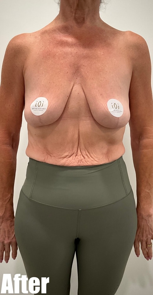 After Image: Arm Lift - front