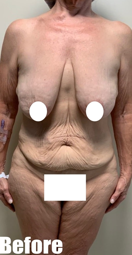 Before Image: Arm Lift - front