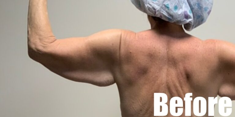 Before Image: Arm Lift - left-back-oblique