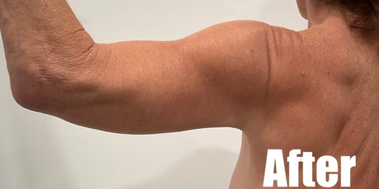 After Image: Arm Lift - left-back-oblique